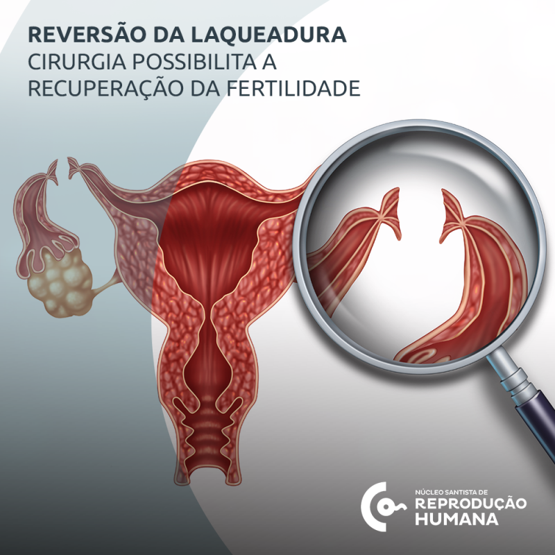 Como é Feita A Laqueadura No Parto Normal - NAZAEDU