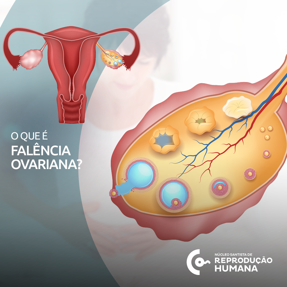Menopausa precoce ou falência ovariana prematura